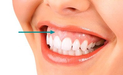 خدمات دندانپزشکی - لبخند لثه ای