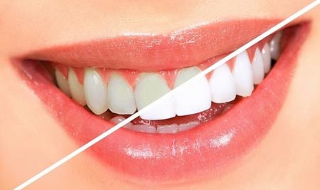 خدمات دندانپزشکی - خدمات سفید کردن دندان